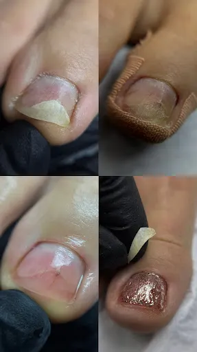 PodoMaster Toruń, podolog, gabinet podologiczny, zabiegi podologiczne, szkolenia, kursy, pedicure, KART, klamra tytanowa